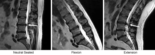Fluctuating Spinal Stenosis Aggravated by the UPRIGHT ® Extension Position
