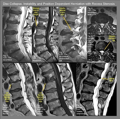 Dysfunctional intersegmental motion with dynamic lateral recess stenosis L2/3 revealed by fmri