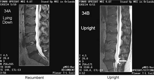 Minimal retrolisthesis at l4-5