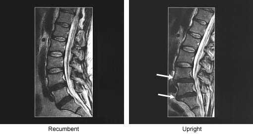Listhesis of l4 over l5 Listhesis of l4 over l5 image
